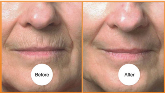 Microneedling-Therapy-For-Stretch-Marks