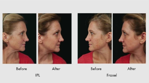 Fractional Laser For Scar Treatment