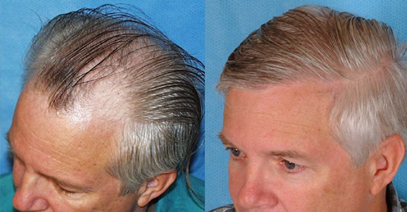 Effective Treatment For Hair Loss