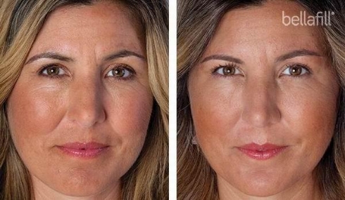 Plump Up Technique For Scar Treatment