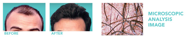 Hair Restoration Therapy