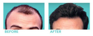 Hair Restoration Therapy