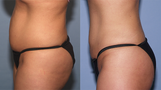 Liposuction-For-Abdomen-2