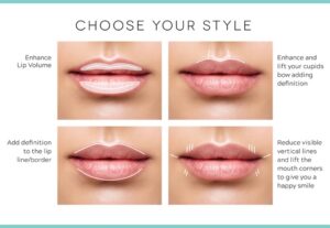 Your Guide to Lips: Threads and Fillers