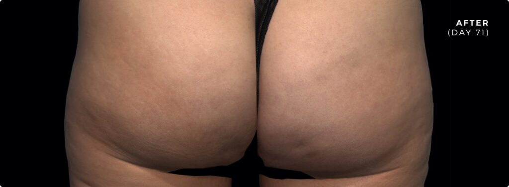 Qwo Cellulite Injection - After