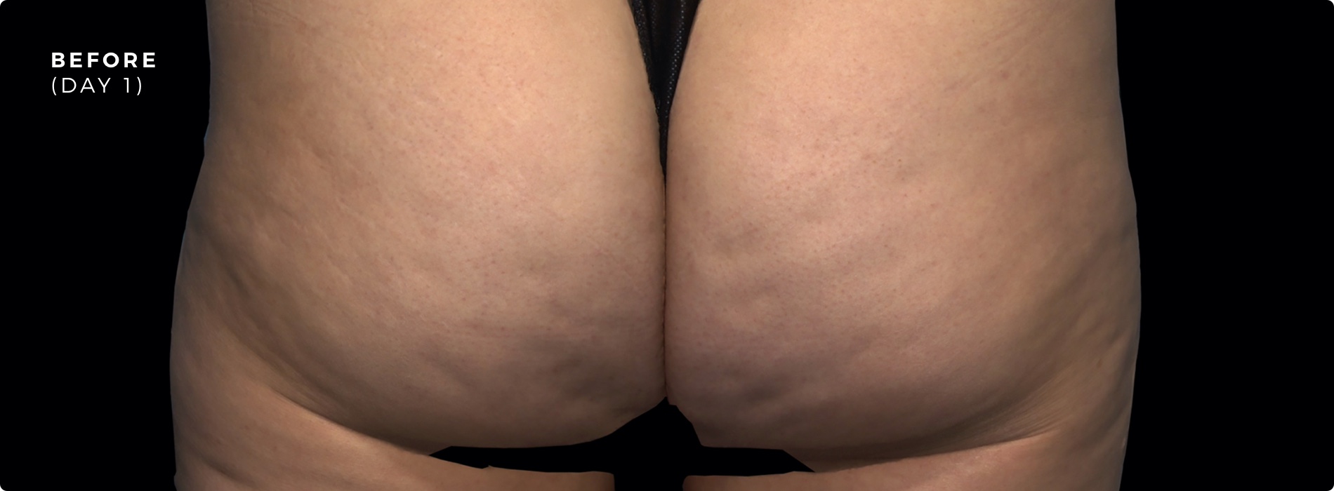 Qwo Cellulite Injection - Before