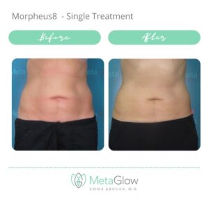 Read more about the article Morpheus 8: Things You Need to Know Before Booking Your Treatment to Get Exactly the Results You Want